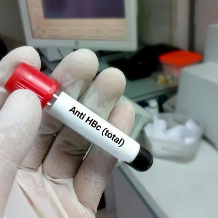ANTI HEPATITIS B CORE ANTIGEN (AHBC) - TOTAL