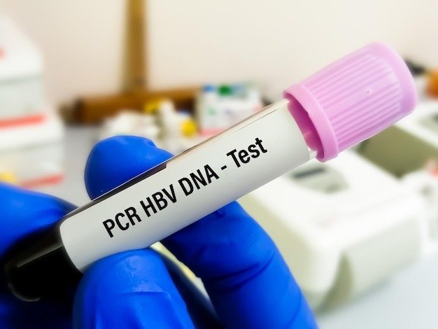 HEPATITIS B VIRUS (HBV) QUALITATIVE PCR