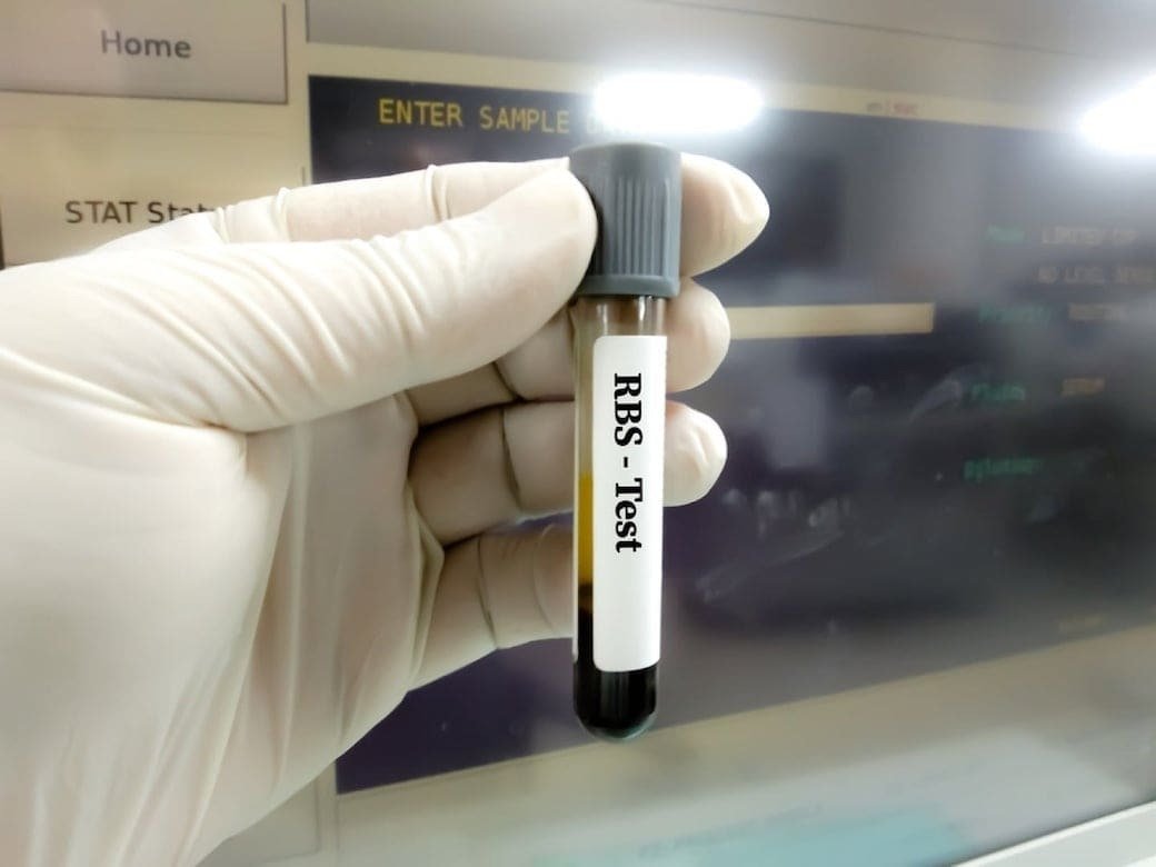 RANDOM BLOOD SUGAR(GLUCOSE)